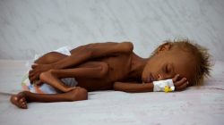 Salem Abdullah Musabih, 6, lies on a bed at a malnutrition intensive care unit at a hospital in the Red Sea port city of Hodaida, Yemen