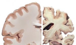A healthy brain compared to a brain affected by a severe case of Alzheimer's Disease. Courtesy of Wikimedia Commons